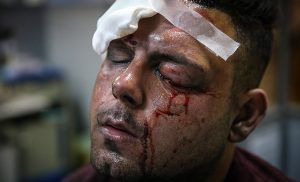 Injured_caused_by_2018_Chaharshanbe_Suri_Farabi_Hospital_Tehran_13961222001320636565777471081701_14526-300x182.jpg
