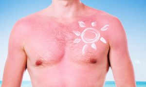sunburn3-1529626020390-300x179.jpg