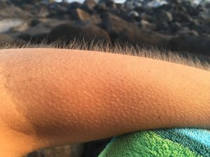 goosebumps-885563_1920-300x225.jpg